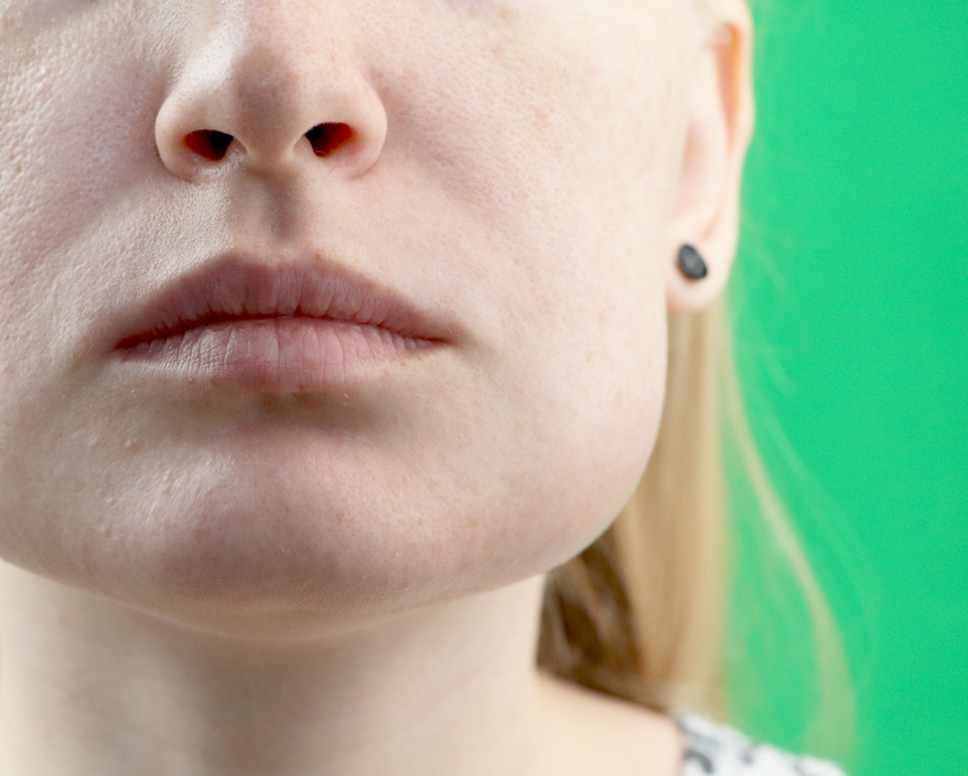 Person with Swollen Cheek   